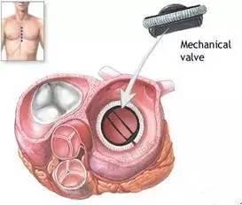 国产心脏瓣膜视频大全,视频大全深度解析